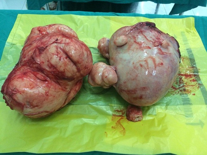 Phẫu thuật cắt u xơ tử cung 4,5kg cho bệnh nhân tâm thần
